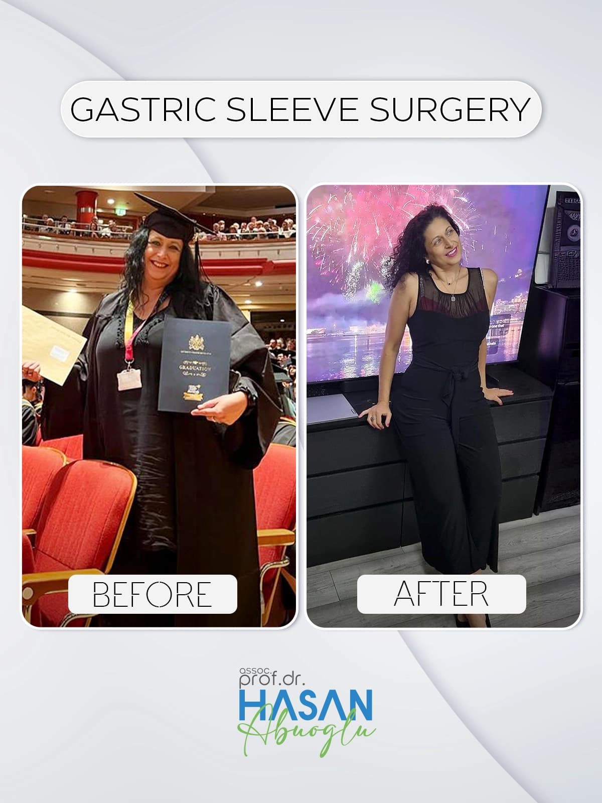 Bariatrik cerrahi öncesi ve sonrası hasta sonucu — gastric sleeve